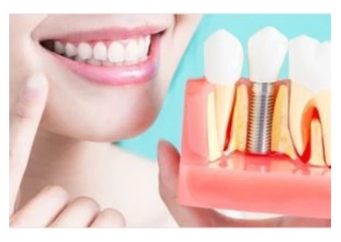 Get your Dental Implants Done With Ease at Endeavour Hills