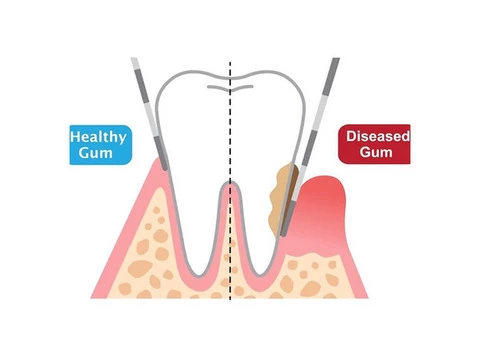 How to Get Rid of Chronic Gum Disease?