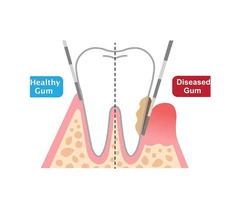 How to Get Rid of Chronic Gum Disease?