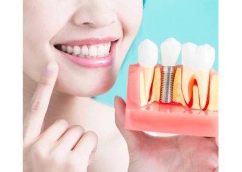 Dental Implants: a Long-lasting Solution to Tooth Loss - 1/4