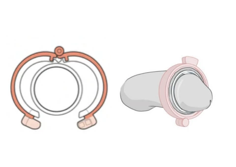 No-Scalpel Vasectomy Melbourne - 2/5