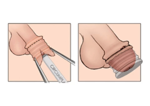 No-Scalpel Vasectomy Melbourne - 4/5