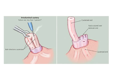 No-Scalpel Vasectomy Melbourne - 5/5