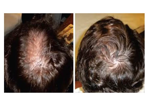 Hair loss treatment in cliftonhill with Zero side effects