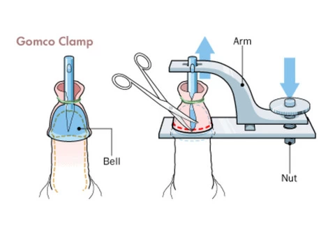 Laser Circumcision Melbourne Clinic - 2/2