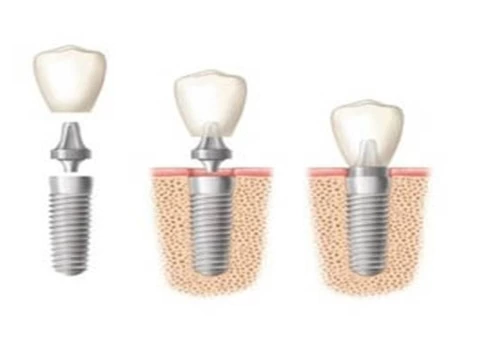 Digital Dental Implants in Sydney - 3/4