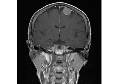 Your most reliable option for Melbourne neurosurgery
