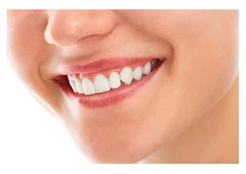 Get a beautiful smile with teeth whitening in Melbourne