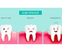 Gingivitis Treatment in Everton Hills