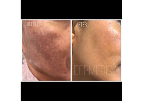 Freckle Removal in Perth | Dermedica