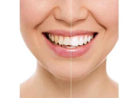 Professional Teeth Whitening in Melbourne - Book Consultation Online Today - 2/3