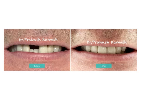 Professional Teeth Whitening in Melbourne - Book Consultation Online Today - 3/3