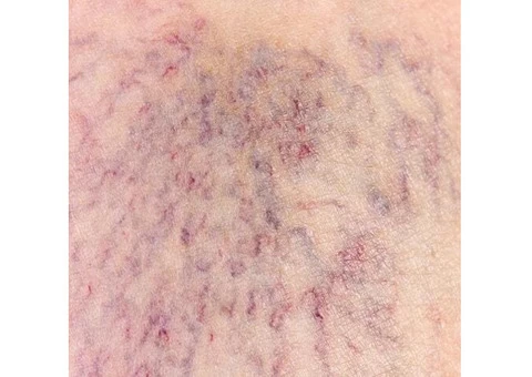 Vascular Specialist Dr Adrian Ling for ‘Sclerotherapy Near Me’ - 2/3