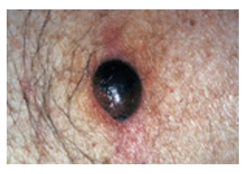 Get Best Skin Treatment at SunSkin Clinic in Australian - 1/3