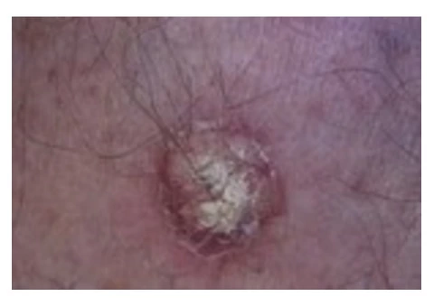 Get Best Skin Treatment at SunSkin Clinic in Australian - 3/3