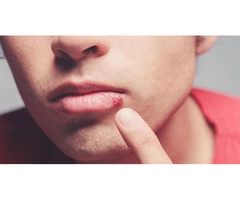 Get to Know the Top Skin Care Expert's Advice for the Treatment of Cold Sores