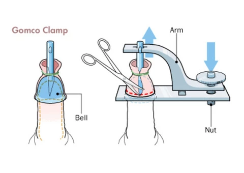 Best Circumcision Melbourne - 2/4
