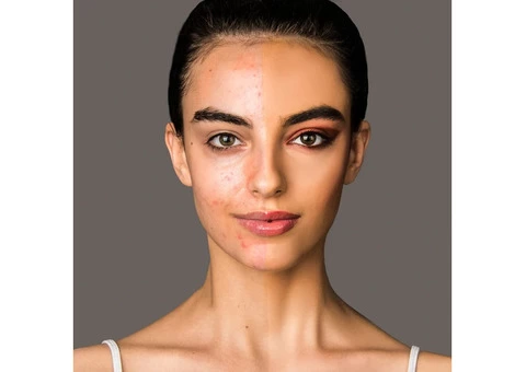 Treat Pigmentation at cosmetic clinic Melbourne