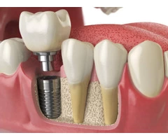 Get High-Quality Dental Implants Treatment In Donvale : Holistic Dental Donvale