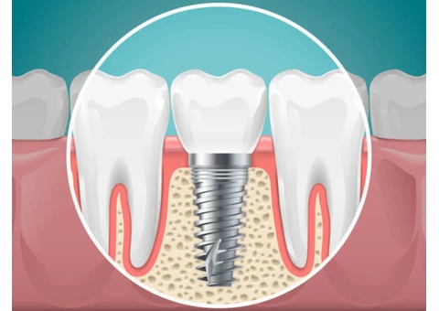 Get High-Quality Dental Implants Treatment In Donvale : Holistic Dental Donvale - 2/2