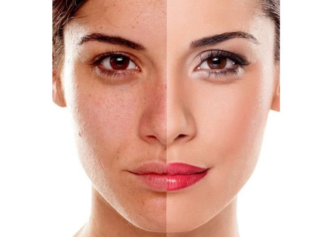 Best Quality Pigmentation Removal Treatment in Drummoyne by IPSN Certified Aestheticians