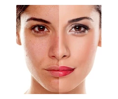 Best Quality Pigmentation Removal Treatment in Drummoyne by IPSN Certified Aestheticians
