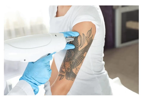 Best Quality Tattoo Removal in Drummoyne by IPSN Certified Aestheticians