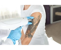 Best Quality Tattoo Removal in Drummoyne by IPSN Certified Aestheticians