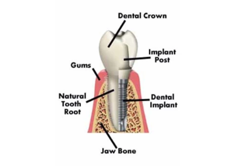 Best Dental Implant Dentist in Sydney