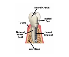 Best Dental Implant Dentist in Sydney