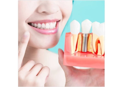 Get Excellent Dental Implant Procedure near Narre Warren