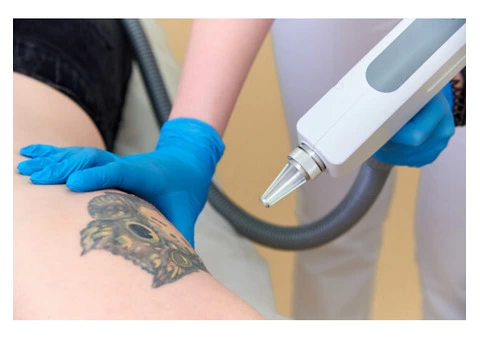 Best Quality Tattoo Removal Treatment  in Drummoyne by IPSN Certified Aestheticians