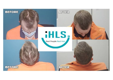 Checkout These Amazing Results of Hair Treatment from Hair Regrowth Expert Australia