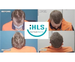 Checkout These Amazing Results of Hair Treatment from Hair Regrowth Expert Australia