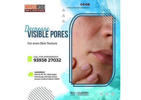 Best Advance Acne and Pimple Treatment In Kurnool || Laser Treatment