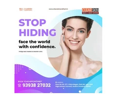 Advanced Melasma Treatment in india