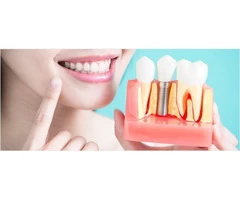 Effective Dental Implant Near Naree Warren