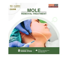 Best Advance Mole Treatment In kurnool || Laser Treatment