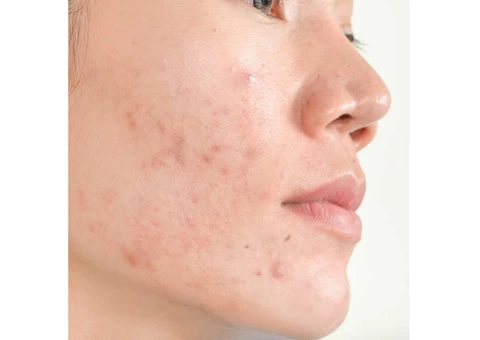 Learn the Best Way to Treat Acne from the Top Health and Skin Care Experts Australia