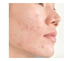 Learn the Best Way to Treat Acne from the Top Health and Skin Care Experts Australia