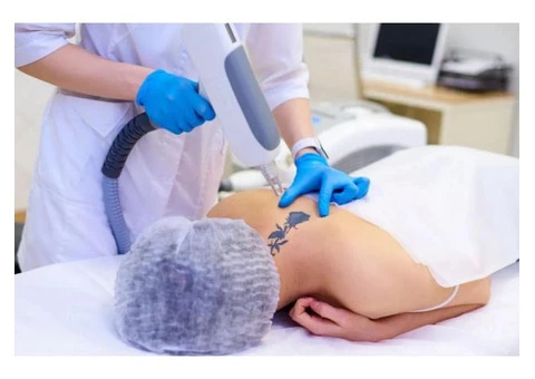 Tattoo Removal Adelaide