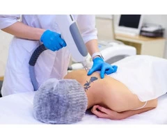 Tattoo Removal Adelaide
