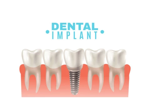 Invisalign Treatment Near Lysterfield