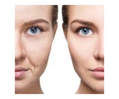 Cosmetic Microneedling