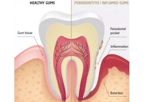 Top Information About Deep Cleaning from Emergency Dentist Near Me in Banksia Grove