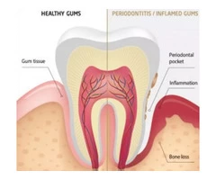 Top Information About Deep Cleaning from Emergency Dentist Near Me in Banksia Grove