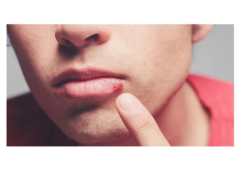 Get to Know the Top Skin Care Expert's Advice for the Treatment of Cold Sores