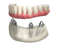 dental implant in Fairfield