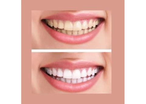 Best Teeth Whitening Treatment