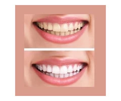 Best Teeth Whitening Treatment